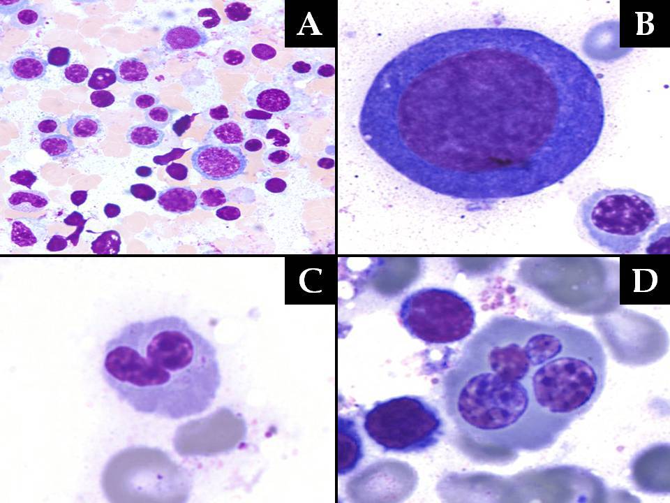 Cellular marrow aspirate smears show a predominance of erythroid precursors (A) and marked dyserythropoiesis with prominent megaloblastoid maturation (B), terminal dyspoiesis including nuclear budding (C) and nuclear dyskaryorrhexis (D).
